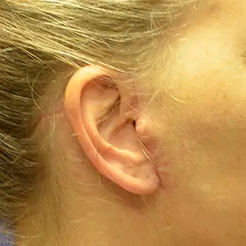 facelift scar shown at 2 weeks after surgery