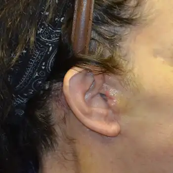 Facelift scar at 10 days after surgery