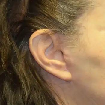 facelift scar shown is 6 weeks after surgery.