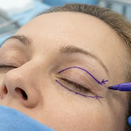eyelid-surgery-incision-area Photo shows were the typical incisions are for upper and lower eyelid surgery.