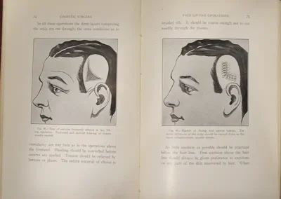 Two-page spread from Dr. Charles Conrad Miller's cosmetic surgery book showing head profiles: left diagram with a scalp incision along the forehead, right diagram of a facelift with tension sutures along the scalp.