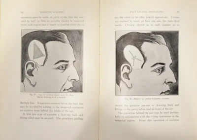 Two side-profile illustrations from Dr. Charles Conrad Miller's cosmetic surgery book of a man's head showing cosmetic incision locations: left panel with a triangular incision behind the ear, right panel showing a closed incision with stitches behind the ear.