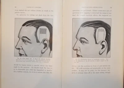 Side-view illustration from Dr. Charles Conrad Miller's cosmetic surgery book showing scalp flap diagrams for cosmetic surgery: a rectangular scalp section marked on the crown area (left) and a similar wound with sutured closure (right).