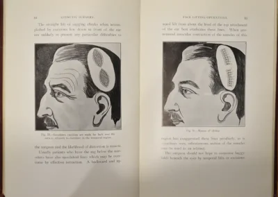 Side view of a man's head from the left, showing incisions placed over the temple area with two oval openings, illustrating a cosmetic-surgery illustration from Dr. Charles Conrad Miller's cosmetic surgery book.
